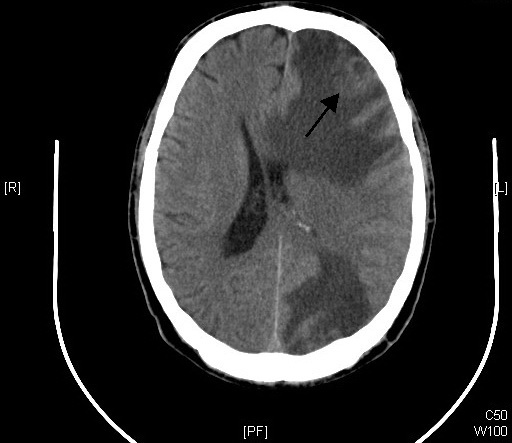 File:Brain - CT scan - Metastatic pulmonary adenocarcinoma Case 239 (7603361920).jpg