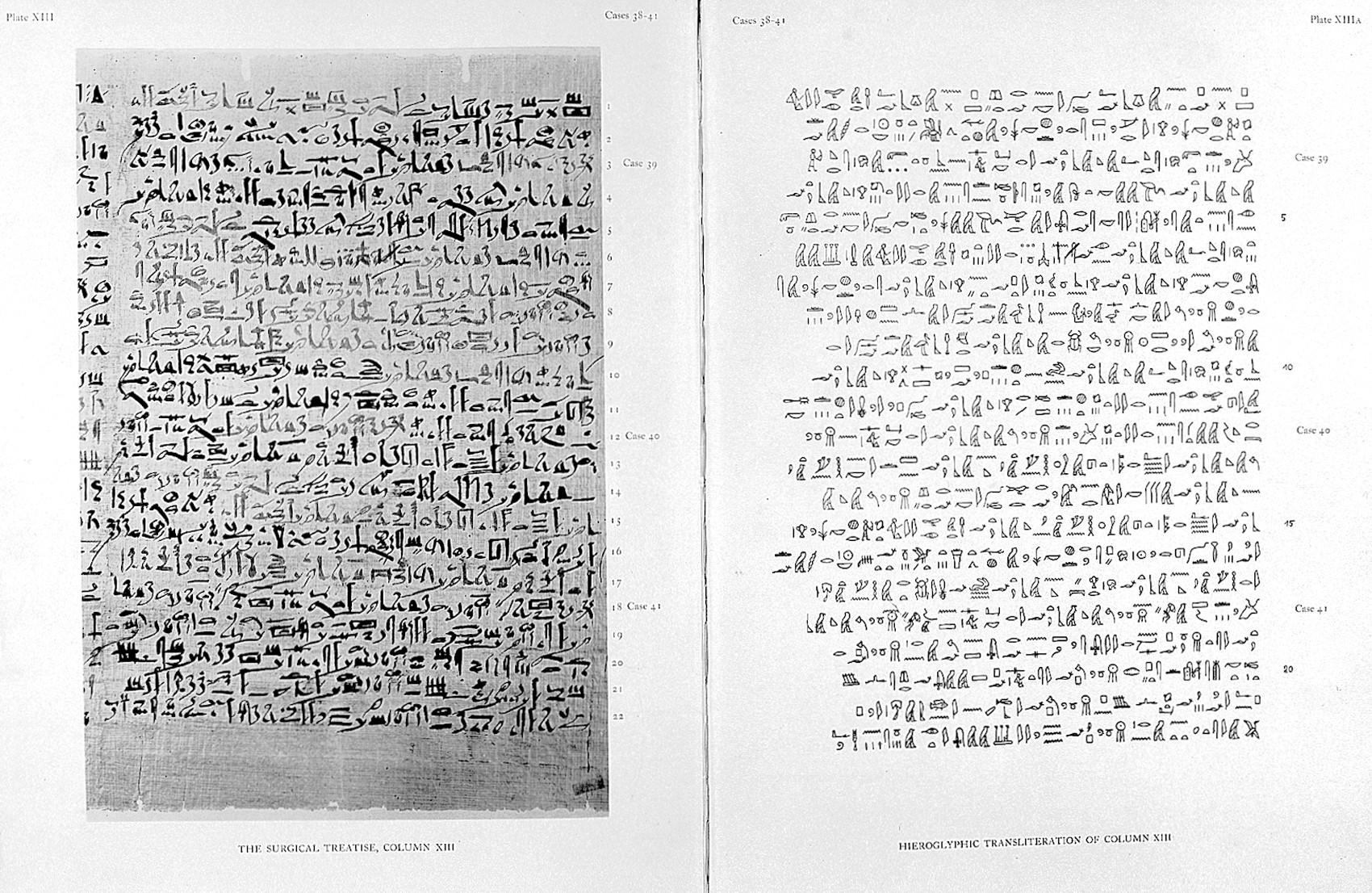 A page from the Edwin Smith Papyrus with Hieroglyphic transliterations on the right